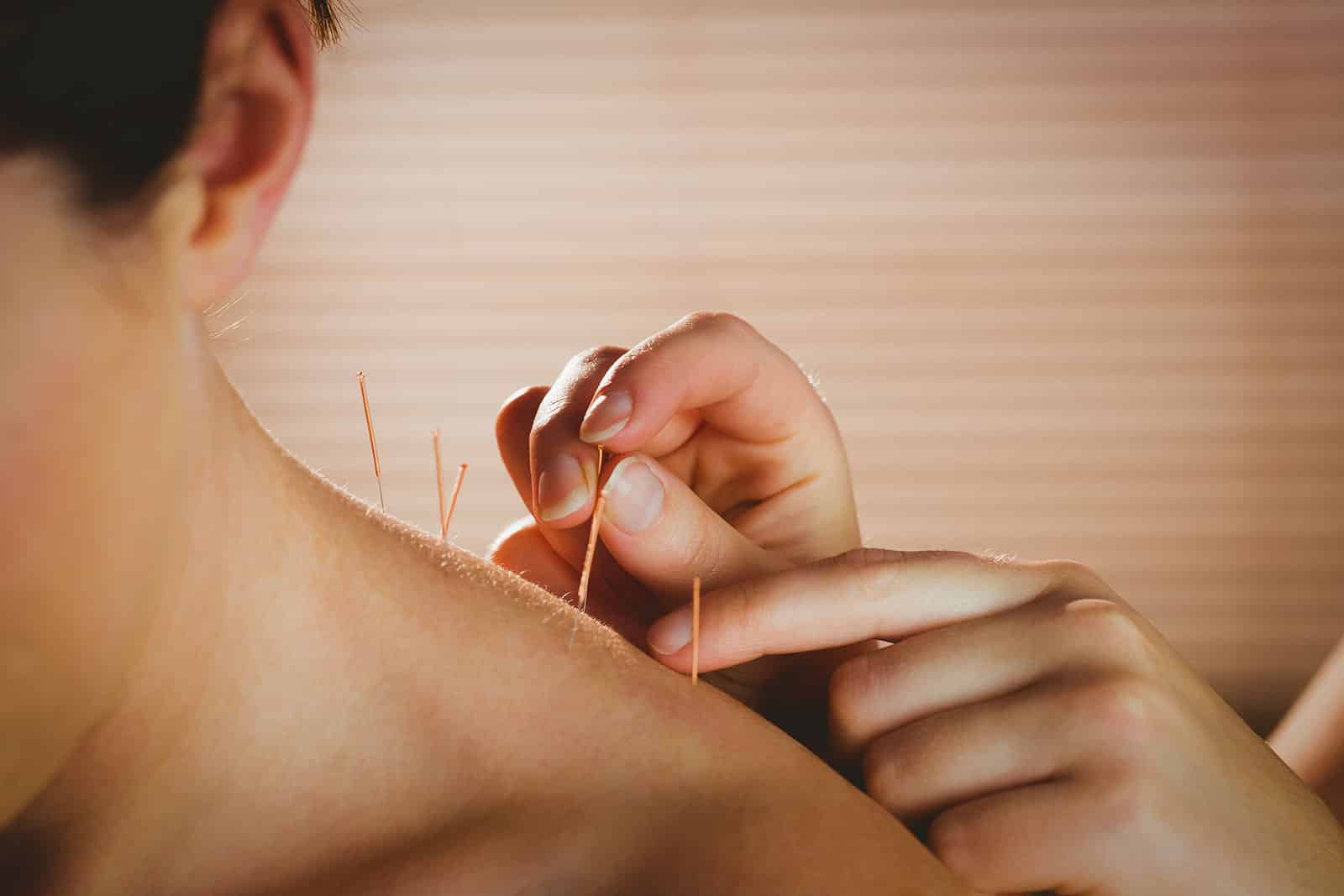 Acupuncture for Detox